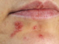4 effective ways to treat herpes