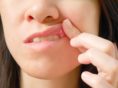 Common Reasons for Sores in the Mouth