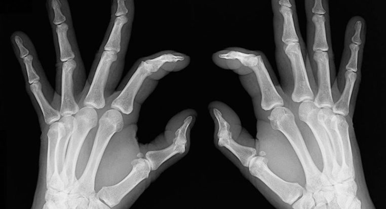 Early signs of rheumatoid arthritis and how to catch them
