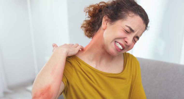 Everything You Need to Know About Shingles Rashes