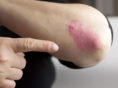 Moderate to severe plaque psoriasis treatment
