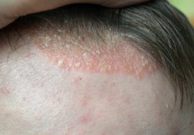 Scalp Psoriasis – Symptoms to Watch out For