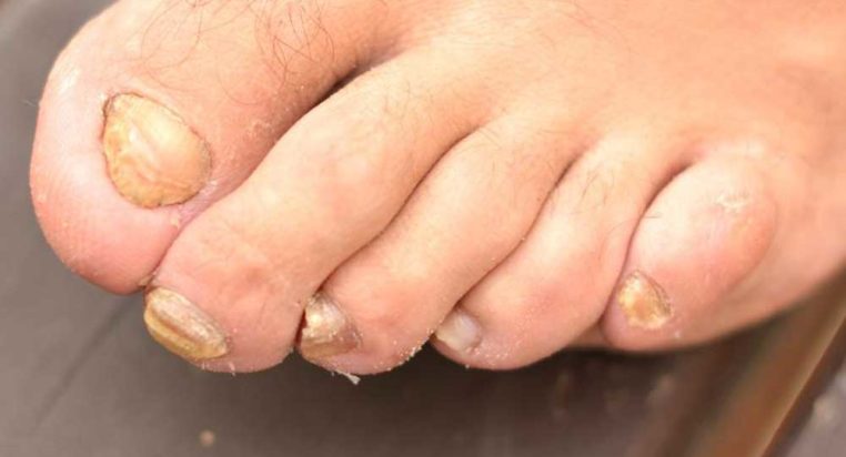 Tips to Treat Nail Fungus Effectively