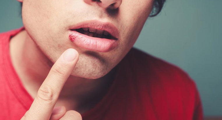 Top 4 FAQs about cold sores