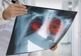Understanding the Various Pulmonary Fibrosis Treatment Methods